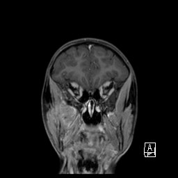 Base of skull rhabdomyosarcoma (Radiopaedia 32196-33142 I 24).jpg