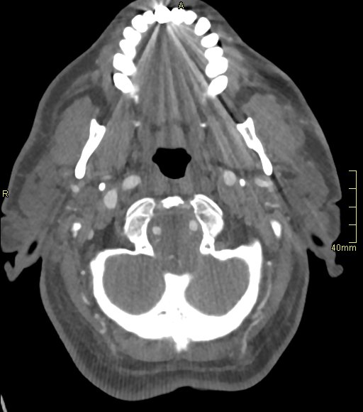 Basilar artery aneurysm (Radiopaedia 56261-62932 A 34).jpg