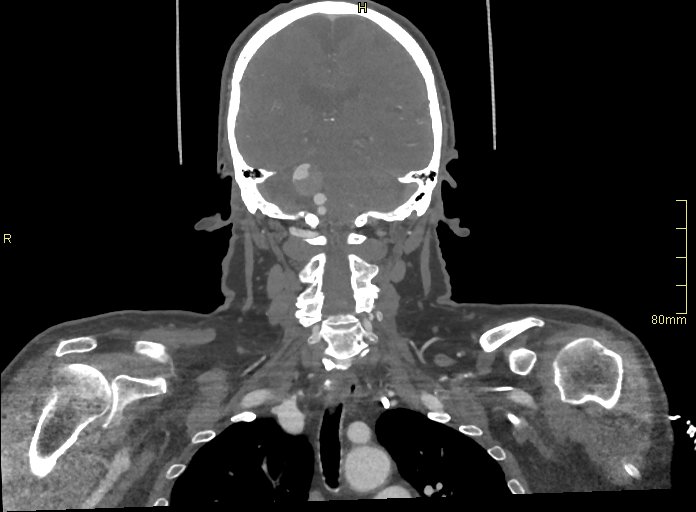 Basilar artery aneurysm (Radiopaedia 56261-62932 B 39).jpg