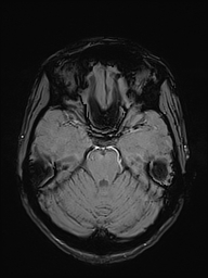 Basilar artery perforator aneurysm (Radiopaedia 82455-97733 Axial SWI 18).jpg