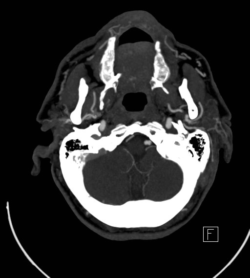 Basilar artery thrombosis (Radiopaedia 26986-27163 A 16).jpg