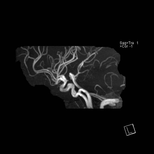 Basilar tip aneurysm (Radiopaedia 26504-26632 D 51).jpg