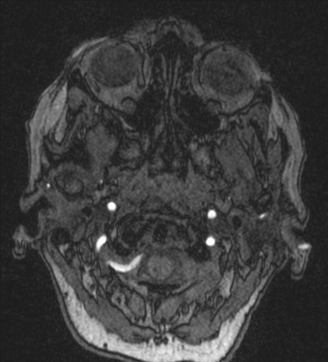 Basilar tip aneurysm (Radiopaedia 26504-26632 MRA 9).jpg