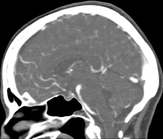 Basilar tip aneurysm with coiling (Radiopaedia 53912-60086 C 64).jpg
