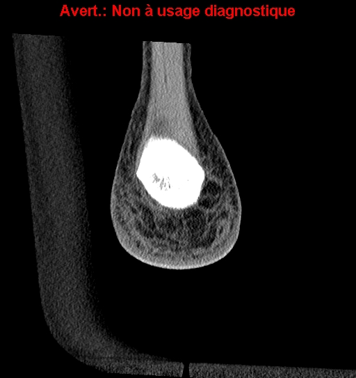 File:Baxter neuropathy (Radiopaedia 25988-26125 Coronal non-contrast 55).jpg