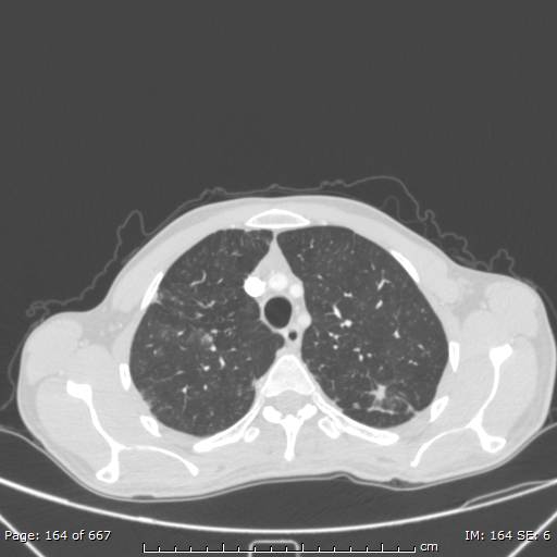 Behçet disease (Radiopaedia 44247-47889 Axial lung window 17).jpg