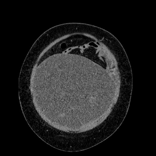 Benign leiomyoma with hydropic features (Radiopaedia 89250-106130 B 23).jpg