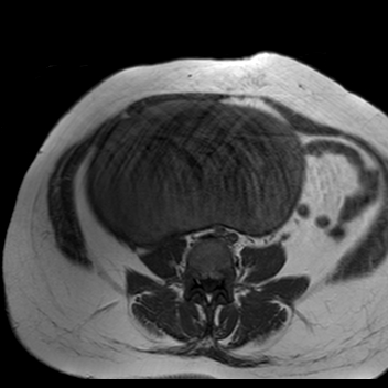 File:Benign seromucinous cystadenoma of the ovary (Radiopaedia 71065-81300 Axial T1 20).jpg