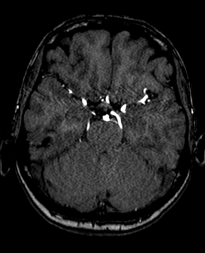 Berry aneurysm of the terminal internal carotid artery (Radiopaedia 88286-104918 Axial TOF 96).jpg