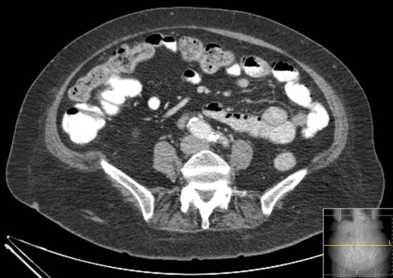 Bicameral celiacomesenteric aneurysm (Radiopaedia 55766-62327 A 40).jpg