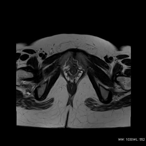 File:Bicornuate uterus- on MRI (Radiopaedia 49206-54297 Axial T2 16).jpg