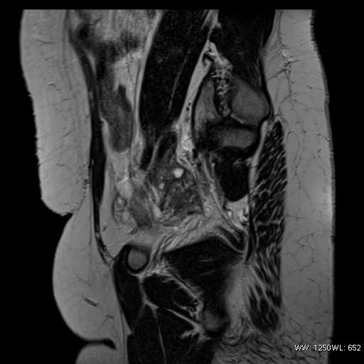 File:Bicornuate uterus- on MRI (Radiopaedia 49206-54297 Sagittal T2 23).jpg