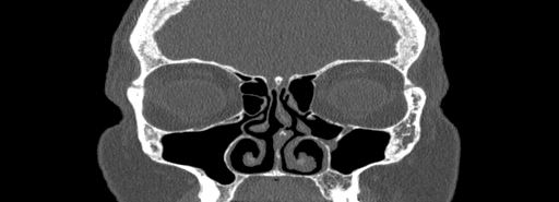 Bilateral Ectopic Infraorbital Nerves (Radiopaedia 49006-54084 Coronal bone window 24).jpg