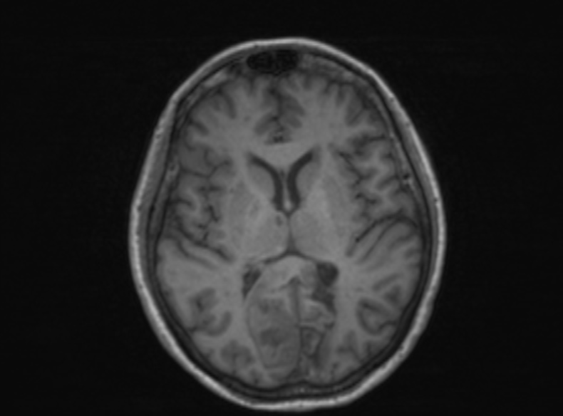 File:Bilateral PCA territory infarction - different ages (Radiopaedia 46200-51784 Axial T1 226).jpg