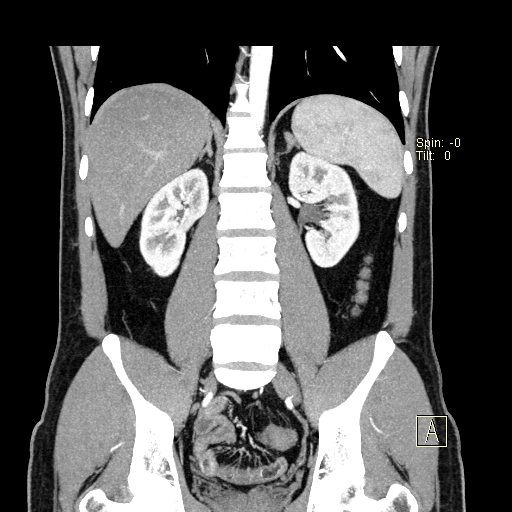 File:Bilateral accessory renal arteries with mild pelvi-ureteric junction (PUJ) obstruction (Radiopaedia 66357-75596 B 32).jpg