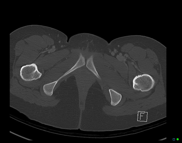 Bilateral acetabular fractures (Radiopaedia 79272-92308 Axial bone window 61).jpg