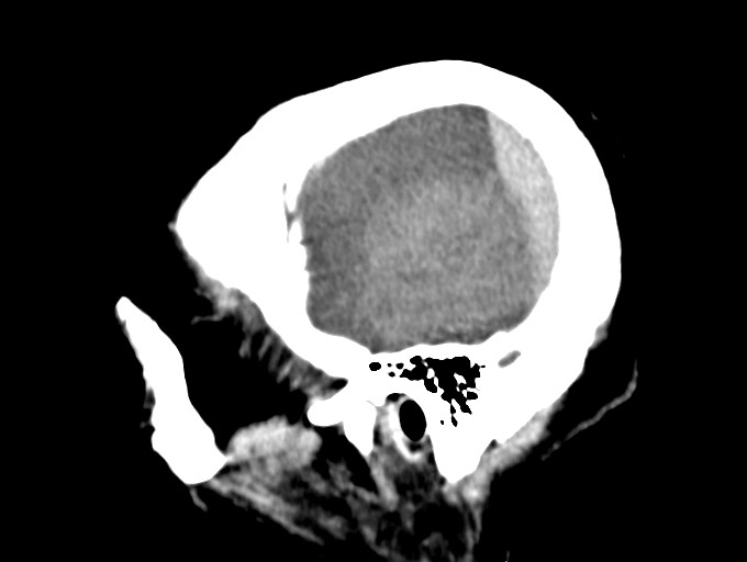 Bilateral acute on chronic subdural hematomas (Radiopaedia 78466-91146 C 12).jpg