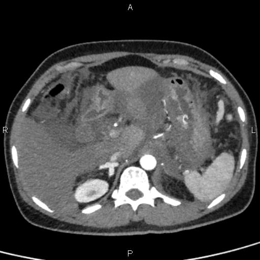 File:Bilateral adrenal gland hyperenhancement in pancreatitis (Radiopaedia 86642-102753 B 32).jpg