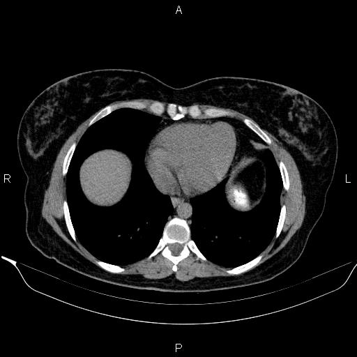 Bilateral adrenal myelolipoma (Radiopaedia 63058-71535 Axial non-contrast 4).jpg