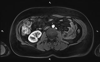 Bilateral adrenal myelolipoma (Radiopaedia 63058-71537 Axial T1 C+ fat sat 59).jpg