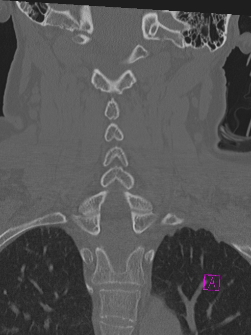 Bilateral atlanto-occipital assimilation (Radiopaedia 28350-28603 Coronal bone window 28).jpg