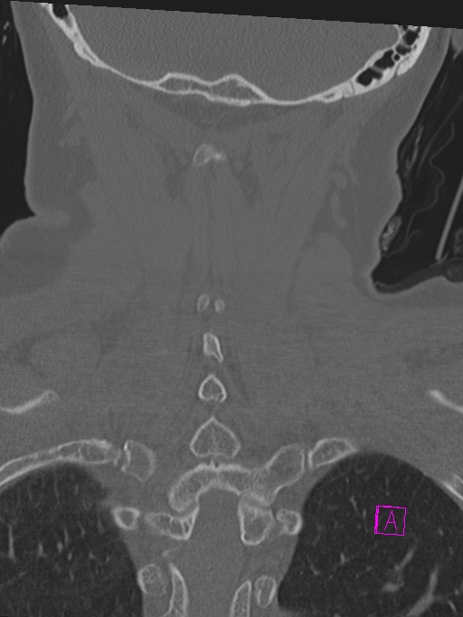 Bilateral atlanto-occipital assimilation (Radiopaedia 28350-28603 Coronal bone window 39).jpg