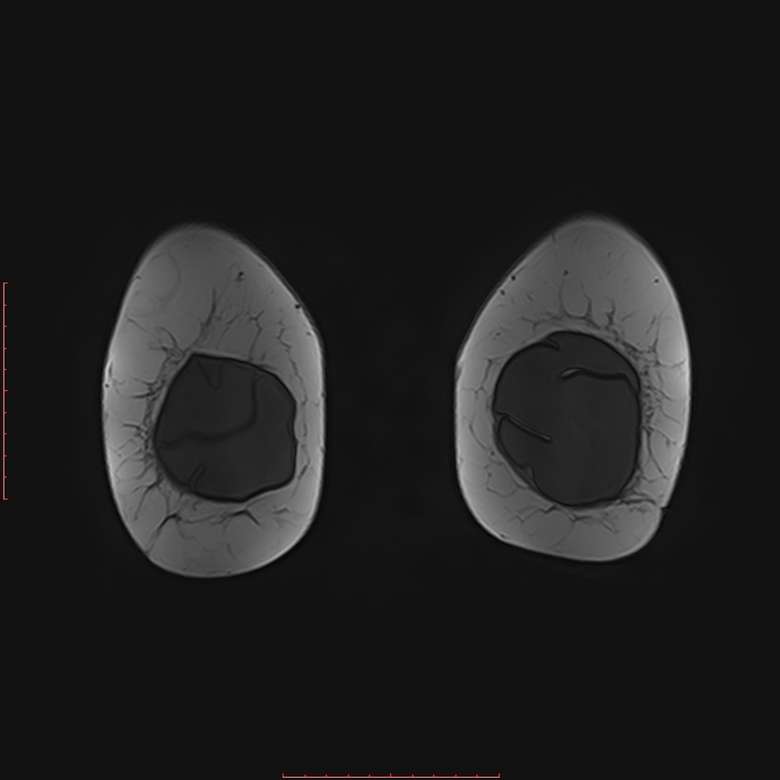 Bilateral breast implant rupture (Radiopaedia 24761-25027 G 98).jpg