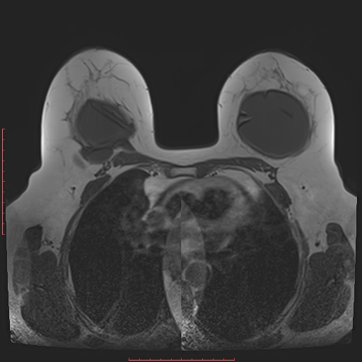 File:Bilateral breast implant rupture (Radiopaedia 24761-25027 T1 16).jpg