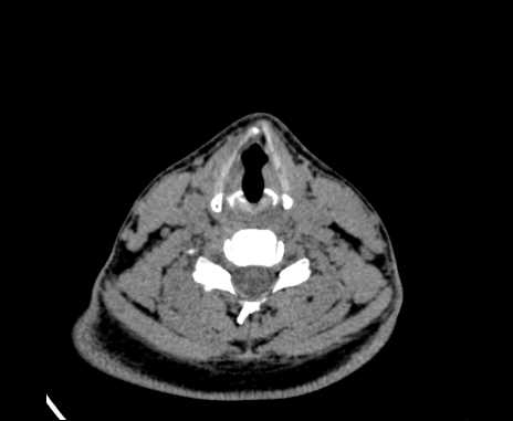 Bilateral carotid body tumors (Radiopaedia 61841-69870 Axial non-contrast 72).jpg