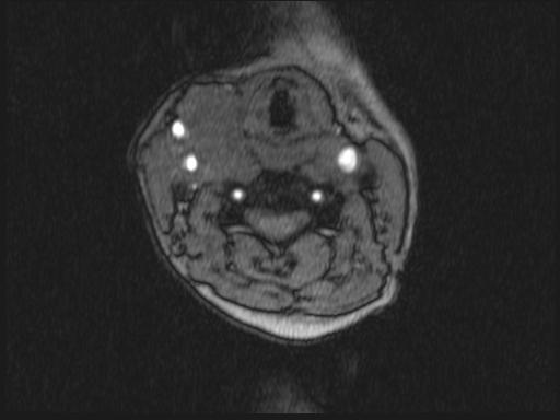 Bilateral carotid body tumors and right glomus jugulare tumor (Radiopaedia 20024-20060 Axial MRA 245).jpg