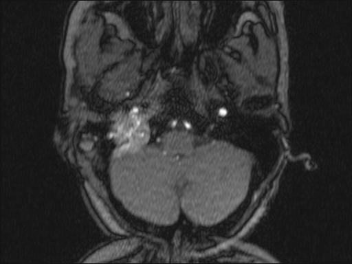 Bilateral carotid body tumors and right glomus jugulare tumor (Radiopaedia 20024-20060 Axial MRA 308).jpg