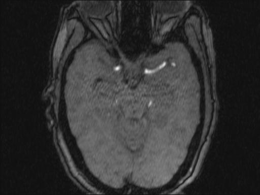 Bilateral carotid body tumors and right glomus jugulare tumor (Radiopaedia 20024-20060 Axial MRA 336).jpg