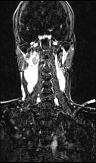 File:Bilateral carotid body tumors and right glomus jugulare tumor (Radiopaedia 20024-20060 MRA 105).jpg