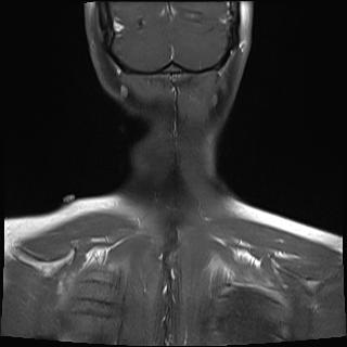 File:Bilateral carotid body tumors and right jugular paraganglioma (Radiopaedia 20024-20060 None 21).jpg