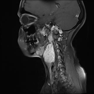 File:Bilateral carotid body tumors and right jugular paraganglioma (Radiopaedia 20024-20060 Sagittal 2).jpg