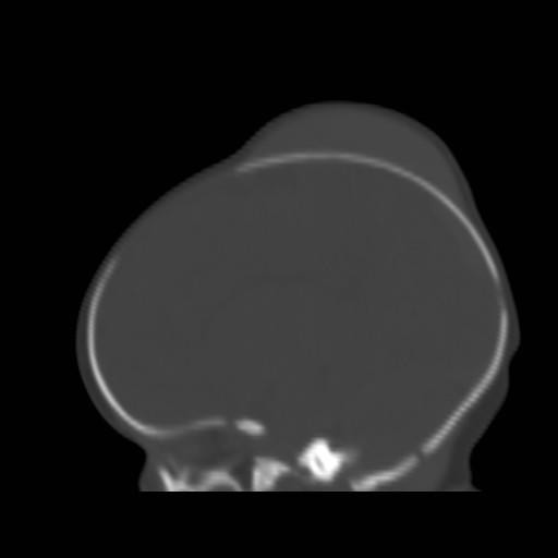 File:Bilateral cephalohematomas and subdural hematomas (Radiopaedia 26778-26929 Sagittal bone window 16).jpg