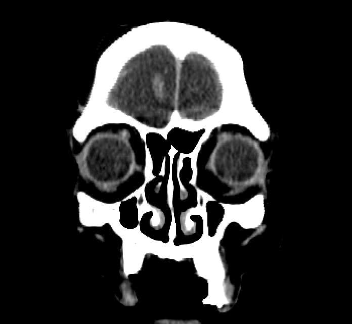 Bilateral ectopia lentis (Radiopaedia 89889-107013 Coronal non-contrast 25).jpg