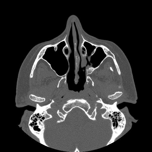 File:Bilateral ectopic infraorbital nerves (Radiopaedia 49006-54084 Axial 3).jpg