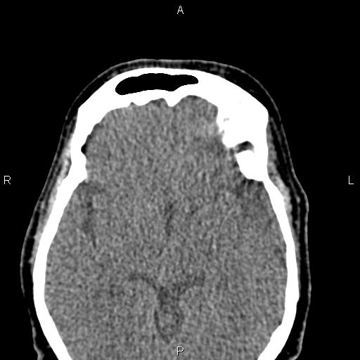 File:Bilateral enlargement of lacrimal glands - sarcoidosis (Radiopaedia 62627-70921 Axial non-contrast 69).jpg