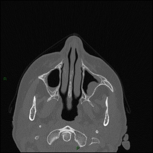 File:Bilateral frontal mucoceles (Radiopaedia 82352-96454 Axial bone window 215).jpg