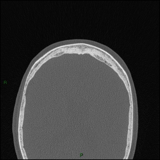 Bilateral frontal mucoceles (Radiopaedia 82352-96454 Axial bone window 41).jpg