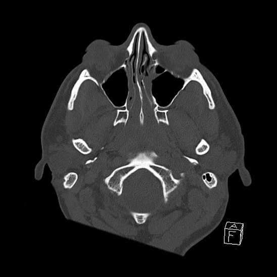 Bilateral occipital condyle fracture (type 2) (Radiopaedia 87675-104089 Axial bone window 11).jpg