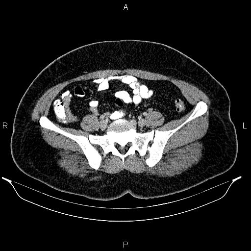 Bilateral ovarian dermoid cysts (Radiopaedia 85785-101603 A 78).jpg