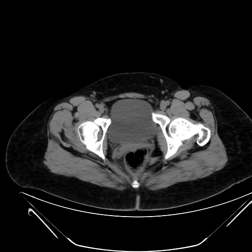 Bilateral ovarian mature cystic teratomas (Radiopaedia 79373-92457 Axial non-contrast 85).jpg