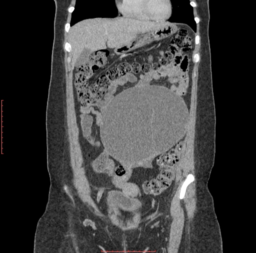 File:Bilateral ovarian serous cystadenocarcinoma with right ovarian torsion (Radiopaedia 32640-33611 B 9).jpg