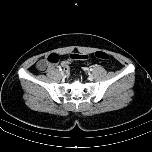Bilateral ovarian teratoma (Radiopaedia 83131-97503 Axial With contrast 26).jpg