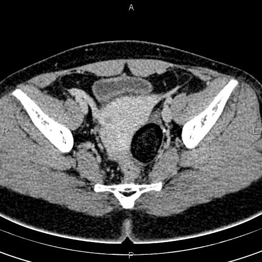 Bilateral ovarian teratoma (Radiopaedia 83131-97503 B 44).jpg