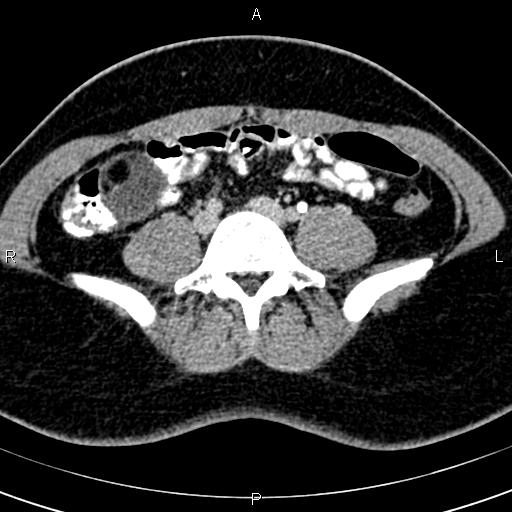 Bilateral ovarian teratoma (Radiopaedia 83131-97503 B 5).jpg