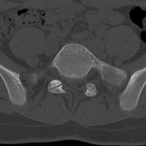 Bilateral pars defect (Radiopaedia 26691-26846 Axial bone window 64).jpg