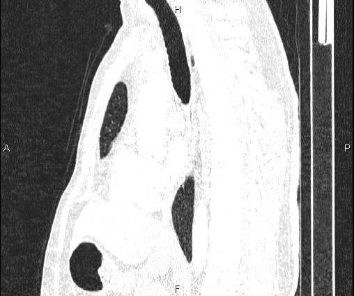 Bilateral pulmonary AVM (Radiopaedia 83134-97505 Sagittal lung window 60).jpg